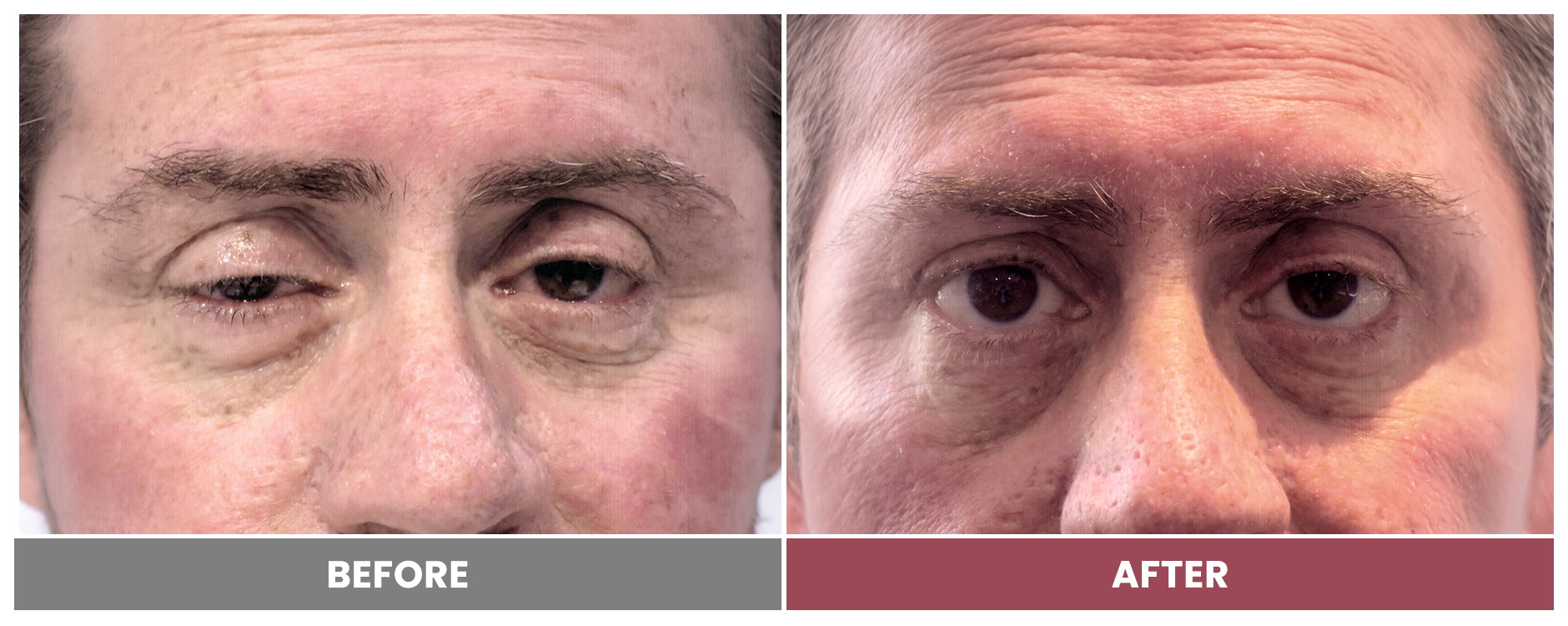 PTOSIS REPAIR - Case 37